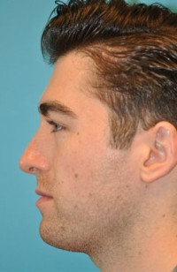 Rhinoplasty (Nose Job) Before and After Photos