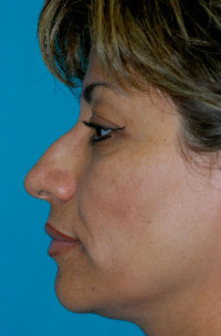 Rhinoplasty (Nose Job) Before and After Photos