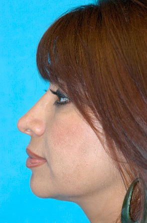 Rhinoplasty (Nose Job) Before and After Photos Case 3658 After Photo Rhinoplasty (Nose Job) Before and After Photos
