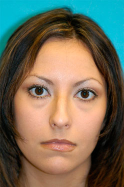 Rhinoplasty (Nose Job) Before and After Photos Case 3709 Before Photo Rhinoplasty (Nose Job) Before and After Photos