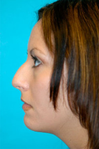 Rhinoplasty (Nose Job) Before and After Photos