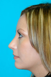 Rhinoplasty (Nose Job) Before and After Photos