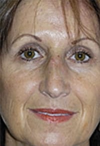 Rhinoplasty (Nose Job) Before and After Photos