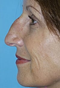 Rhinoplasty (Nose Job) Before and After Photos