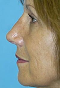 Rhinoplasty (Nose Job) Before and After Photos