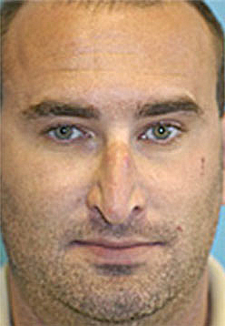 Rhinoplasty (Nose Job) Before and After Photos