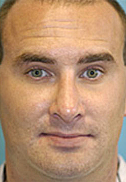 Rhinoplasty (Nose Job) Before and After Photos