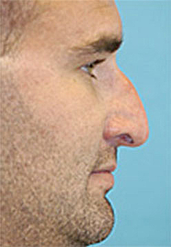 Rhinoplasty (Nose Job) Before and After Photos