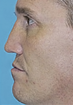 Rhinoplasty (Nose Job) Before and After Photos Case 3823 After Photo Rhinoplasty (Nose Job) Before and After Photos