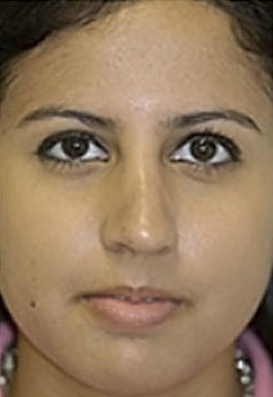 Rhinoplasty (Nose Job) Before and After Photos Case 3864 After Photo Rhinoplasty (Nose Job) Before and After Photos