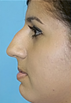 Rhinoplasty (Nose Job) Before and After Photos Case 3864 Before Photo Rhinoplasty (Nose Job) Before and After Photos
