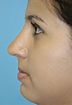 Rhinoplasty (Nose Job) Before and After Photos Case 3864 After Photo Rhinoplasty (Nose Job) Before and After Photos