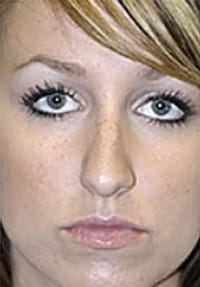 Rhinoplasty (Nose Job) Before and After Photos