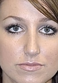 Rhinoplasty (Nose Job) Before and After Photos