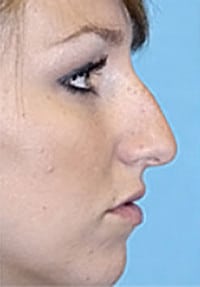 Rhinoplasty (Nose Job) Before and After Photos