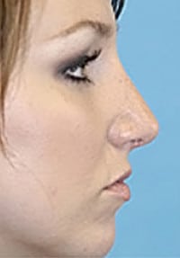 Rhinoplasty (Nose Job) Before and After Photos