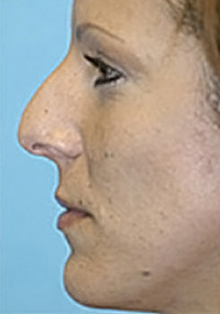 Rhinoplasty (Nose Job) Before and After Photos