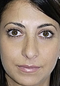 Rhinoplasty (Nose Job) Before and After Photos Case 3918 Before Photo Rhinoplasty (Nose Job) Before and After Photos