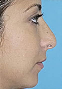 Rhinoplasty (Nose Job) Before and After Photos