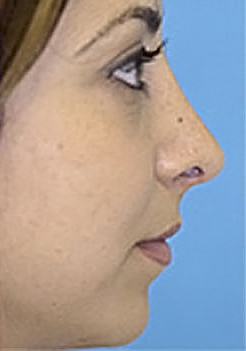 Rhinoplasty (Nose Job) Before and After Photos Case 3918 After Photo Rhinoplasty (Nose Job) Before and After Photos