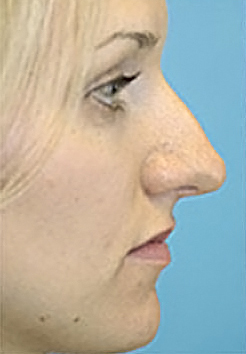 Rhinoplasty (Nose Job) Before and After Photos Case 3929 Before Photo Rhinoplasty (Nose Job) Before and After Photos