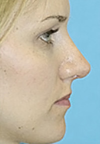 Rhinoplasty (Nose Job) Before and After Photos