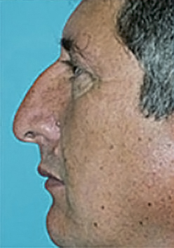 Rhinoplasty (Nose Job) Before and After Photos Case 3941 Before Photo Rhinoplasty (Nose Job) Before and After Photos