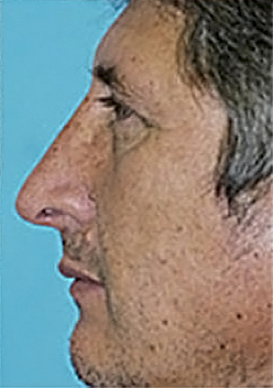 Rhinoplasty (Nose Job) Before and After Photos Case 3941 After Photo Rhinoplasty (Nose Job) Before and After Photos