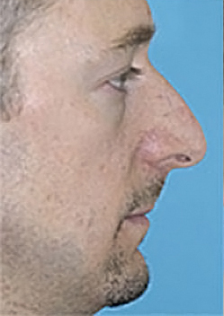 Rhinoplasty (Nose Job) Before and After Photos