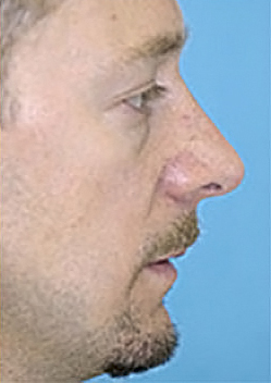 Rhinoplasty (Nose Job) Before and After Photos Case 3947 After Photo Rhinoplasty (Nose Job) Before and After Photos
