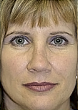 Rhinoplasty (Nose Job) Before and After Photos Case 3953 After Photo Rhinoplasty (Nose Job) Before and After Photos