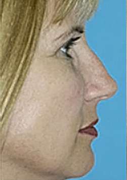 Rhinoplasty (Nose Job) Before and After Photos Case 3953 Before Photo Rhinoplasty (Nose Job) Before and After Photos