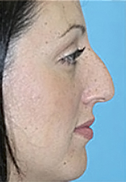 Rhinoplasty (Nose Job) Before and After Photos