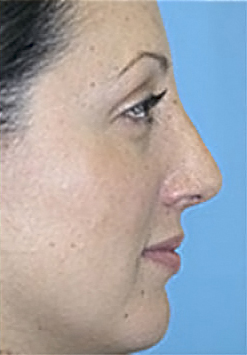 Rhinoplasty (Nose Job) Before and After Photos