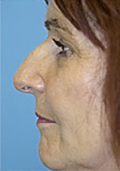Rhinoplasty (Nose Job) Before and After Photos Case 3965 Before Photo Rhinoplasty (Nose Job) Before and After Photos