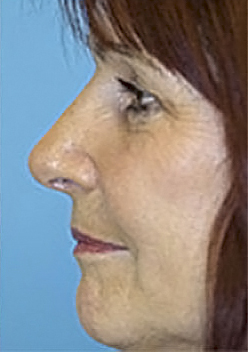 Rhinoplasty (Nose Job) Before and After Photos Case 3965 After Photo Rhinoplasty (Nose Job) Before and After Photos