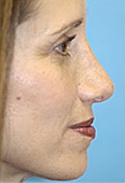 Rhinoplasty (Nose Job) Before and After Photos Case 3977 After Photo Rhinoplasty (Nose Job) Before and After Photos