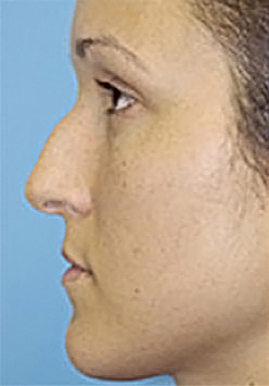 Rhinoplasty (Nose Job) Before and After Photos