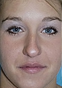 Rhinoplasty (Nose Job) Before and After Photos Case 4025 Before Photo Rhinoplasty (Nose Job) Before and After Photos