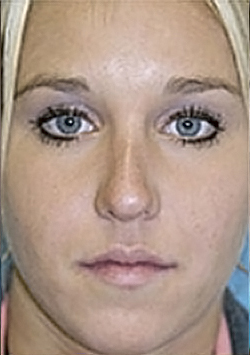 Rhinoplasty (Nose Job) Before and After Photos Case 4025 After Photo Rhinoplasty (Nose Job) Before and After Photos