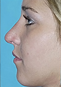 Rhinoplasty (Nose Job) Before and After Photos Case 4025 Before Photo Rhinoplasty (Nose Job) Before and After Photos