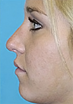 Rhinoplasty (Nose Job) Before and After Photos