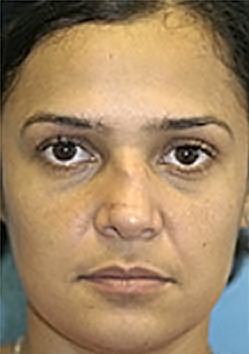 Rhinoplasty (Nose Job) Before and After Photos Case 4039 Before Photo Rhinoplasty (Nose Job) Before and After Photos