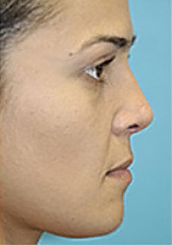 Rhinoplasty (Nose Job) Before and After Photos Case 4039 After Photo Rhinoplasty (Nose Job) Before and After Photos