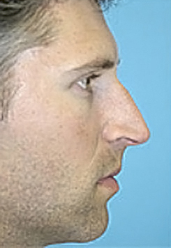Rhinoplasty (Nose Job) Before and After Photos Case 4051 Before Photo Rhinoplasty (Nose Job) Before and After Photos