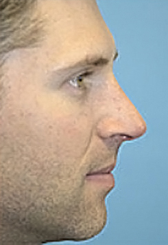 Rhinoplasty (Nose Job) Before and After Photos Case 4051 After Photo Rhinoplasty (Nose Job) Before and After Photos