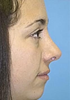 Rhinoplasty (Nose Job) Before and After Photos