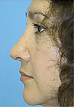 Rhinoplasty (Nose Job) Before and After Photos Case 4075 After Photo Rhinoplasty (Nose Job) Before and After Photos