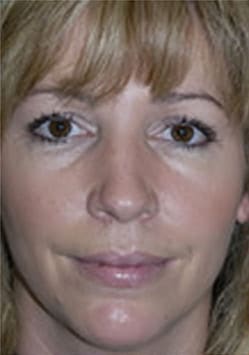 Rhinoplasty (Nose Job) Before and After Photos