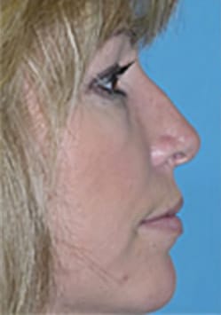 Rhinoplasty (Nose Job) Before and After Photos
